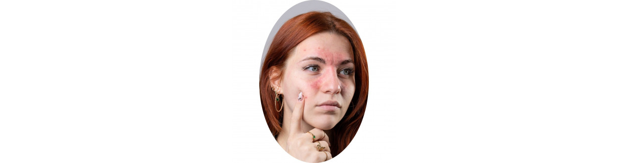 Rosácea e Vermelhidão